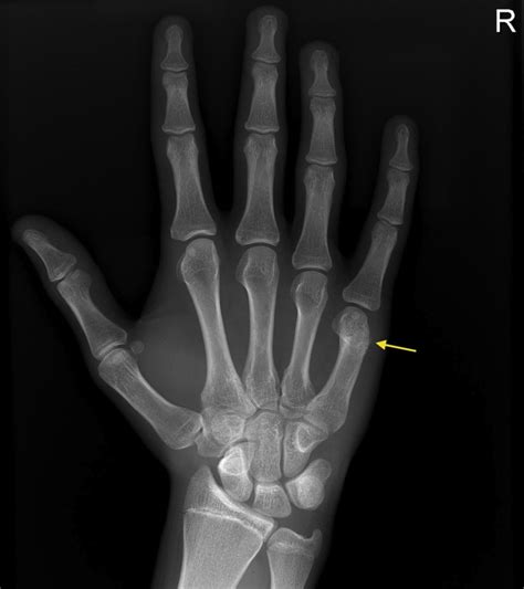 non displaced boxer fracture